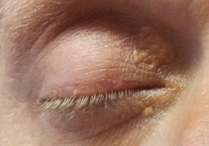 image of xanthoma plaques on the eyelids